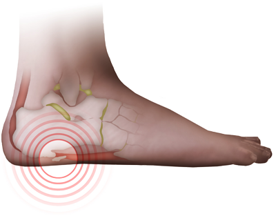 Пяточная шпора — выход есть!