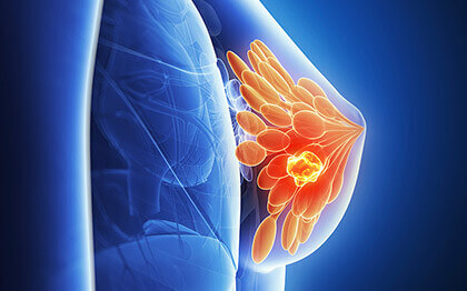 УЗИ молочных желез в Санкт-Петербурге