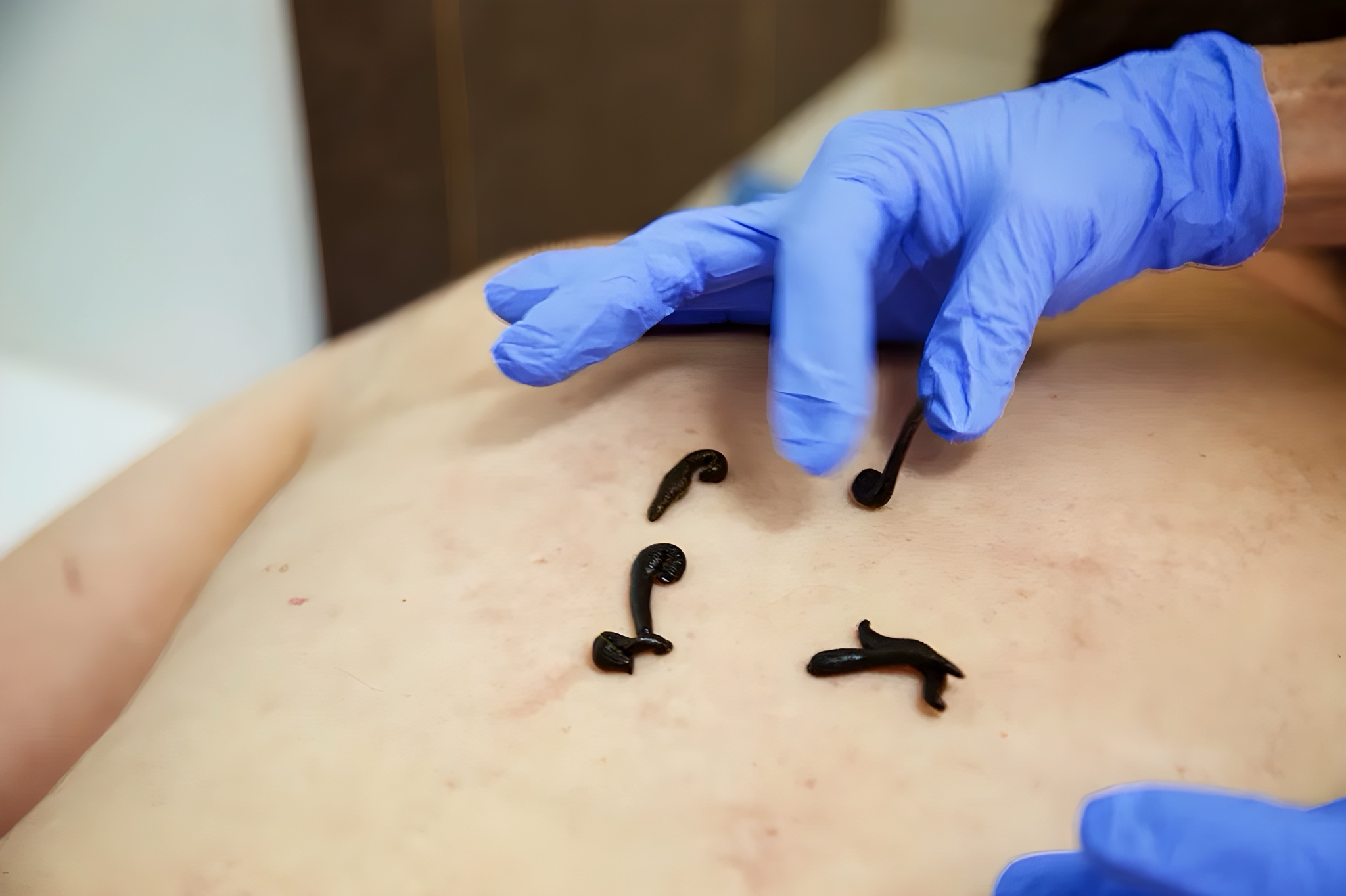 Использование гирудотерапии в комплексной системе реабилитации