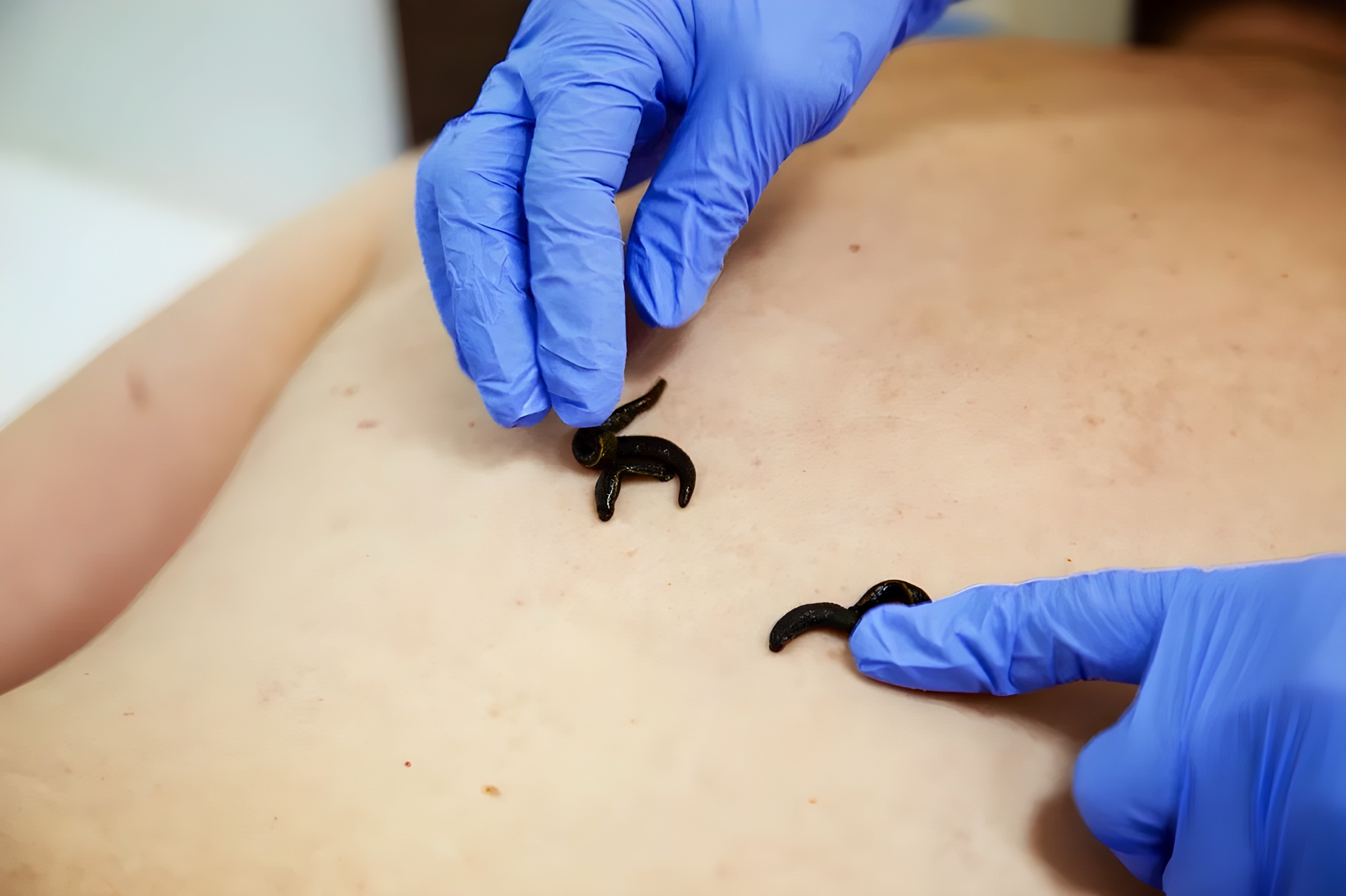 Почему пиявки помогают?