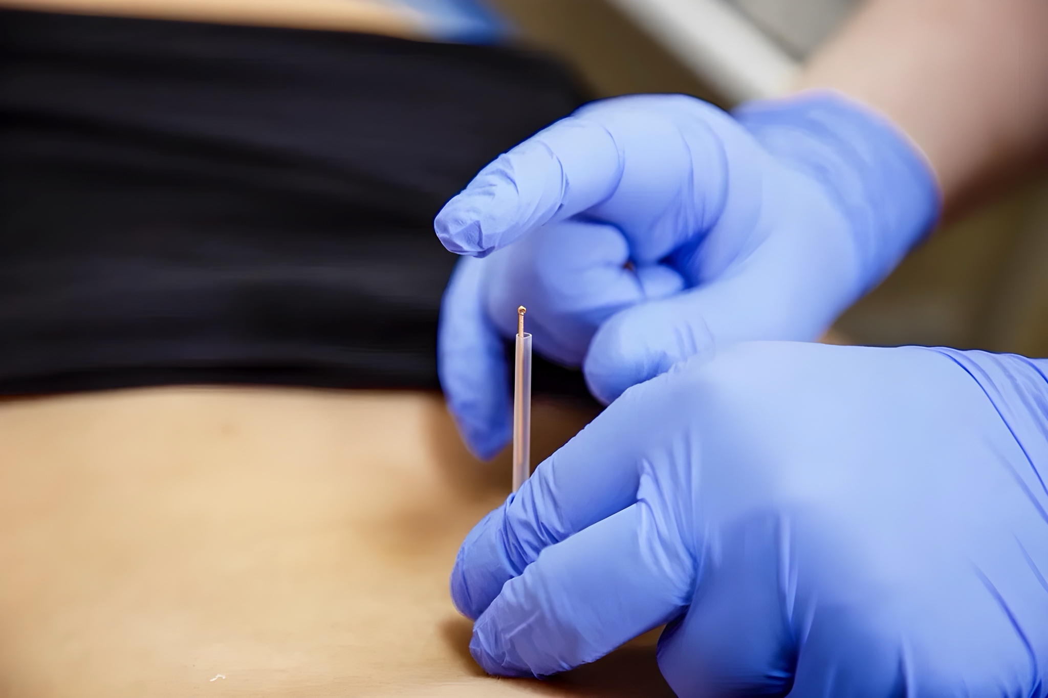 Иглоукалывание: восточная диковинка или полезный метод?