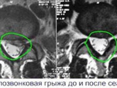 Новые результаты лечения!